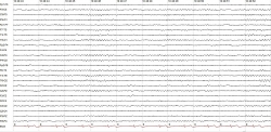 Eletroencefalograma - Clínica NeuroSaúde - Diagnóstico em Neurologia