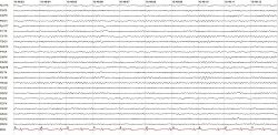 Eletroencefalograma - Clínica NeuroSaúde - Diagnóstico em Neurologia