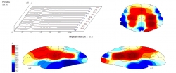 Eletroencefalograma com mapeamento cerebral - Clínica NeuroSaúde - Diagnóstico em Neurologia