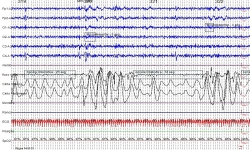 Polissonografia - Apneia - Clínica NeuroSaúde - Diagnóstico em Neurologia